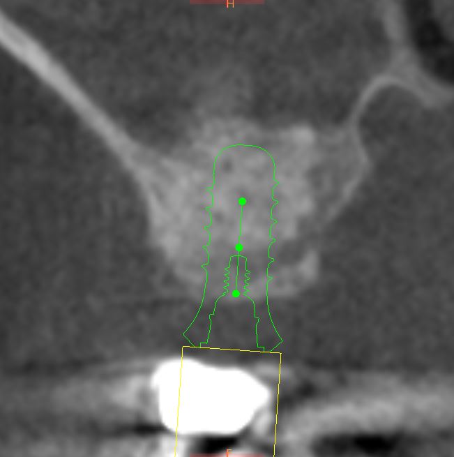 PostSinus