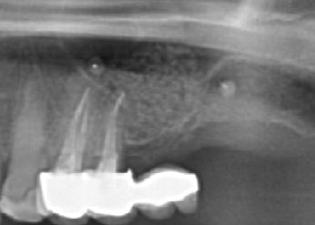 PostSinus1
